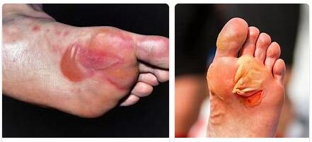 Blisters on the Feet